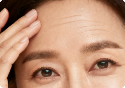 Laser treatment for acne