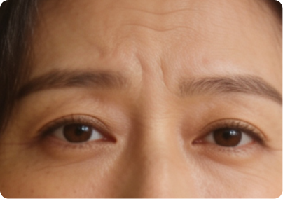 Frown Lines